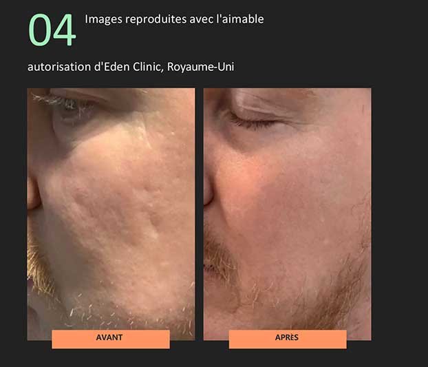 Avant / Après soin NeoGen Evo